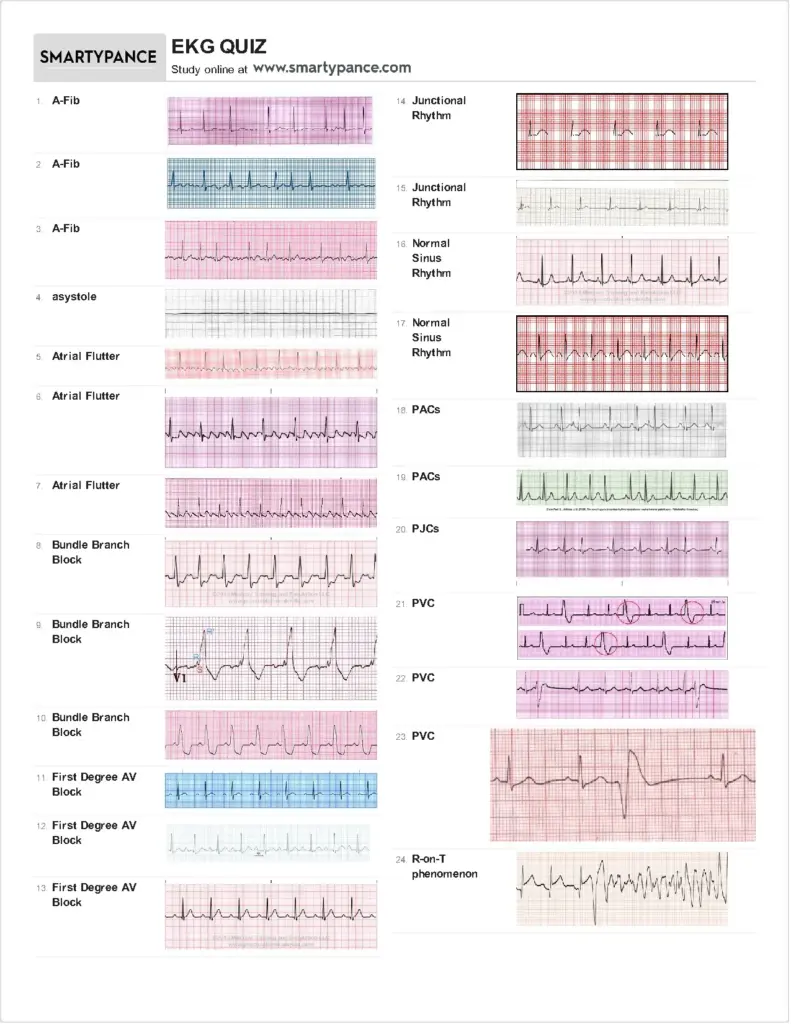 Practice EKG Strips with Answers for Medical Students